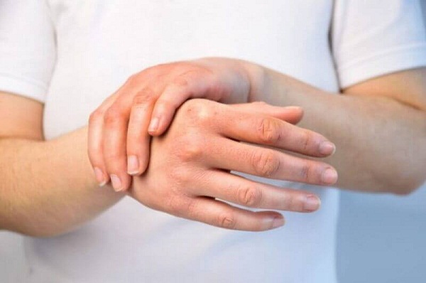 Nhiều người trẻ cũng bị nám da tay.