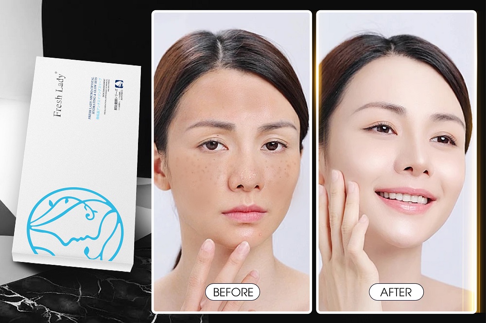 Làm mờ da mặt bị nám từ Combo Fresh Lady