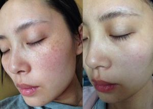 Chị Trang chia sẻ thêm: "Lúc đầu cũng bán tính bán nghi. Nhưng khi liên hệ với cửa hàng chính hãng, được hỗ trợ tư vấn. Thì đúng là da có cải thiện rõ rệt sau 1 thời gian".