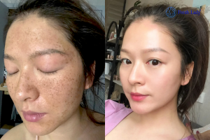 Sau khi sinh bé thứ hai, chị Nhàn – 35 tuổi, sống tại Bến Tre. Đang phải đối diện với tình trạng nám lan rộng.