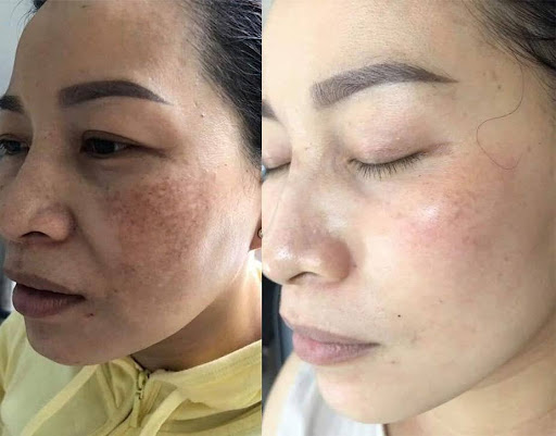 kem trị nám Fresh Lady