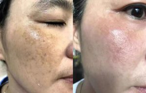 Làn da bị nám thường yếu và nhạy cảm, vì vậy việc lựa chọn phương pháp tẩy da chết cũng cần kỹ lưỡng.