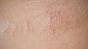 Xuất hiện các nốt đỏ nhỏ, có thể có mụn nước li ti gây ngứa rát