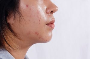 Bệnh da liễu vào mùa hè thường xuất phát từ nhiều nguyên nhân.