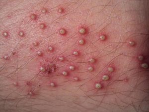 Xuất hiện các nốt đỏ, có thể có mủ, gây đau hoặc ngứa