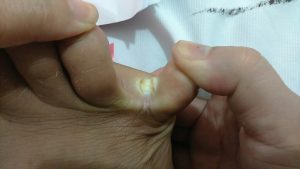 Da chân bong tróc, nứt nẻ, có cảm giác ngứa rát.