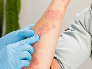 Tình trạng da đỏ, rát, có thể phồng rộp sau vài giờ tiếp xúc với nắng