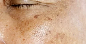 Rối loại nội tiết tố sau tuổi 30 hoặc sau sinh cũng làm hình thành đồi mồi