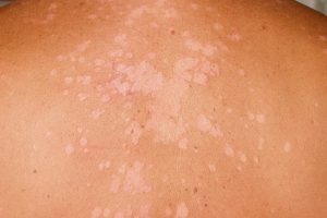 Nắng nóng kéo dài, gây ra các bệnh da liễu làm ảnh hưởng đến thẩm mỹ và tâm lí bệnh nhân