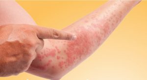 Nổi mẩn đỏ, ngứa, đôi khi có cảm giác châm chích.