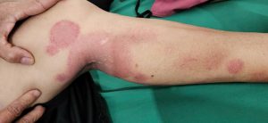 Vùng da bị kích ứng trở nên đỏ, khô làm ngứa ngáy, rát da