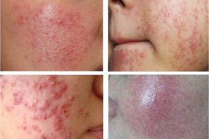 Da bị nhiễm corticoid do không thải độc da định kỳ.
