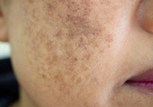 Hormone estrogen trong thuốc sẽ làm tế bào melanocyte – Tế bào sản xuất melanin. Kết quả là da sản xuất nhiều sắc tố hơn