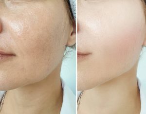 Kiên trì dùng sau 28 ngày, làn da của chị như được thay mới. Đến chồng chị còn bất ngờ nghĩ chị vừa đi thẩm mỹ viện về.