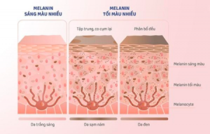 Tế bào sừng yếu gây nám ở gò má, trán, cằm.