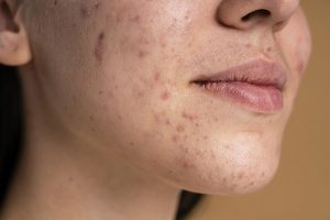 Mất cân bằng hormone do trao đổi chất ảnh hưởng cũng dẫn đến mụn nội tiết ở cằm, quai hàm.