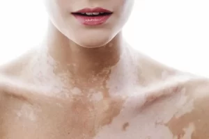 Làn da bị giảm sắc tố có thể đến từ nhiều nguyên nhân, gây ra sự mất thẩm mỹ và vẻ tự nhiên của làn da.