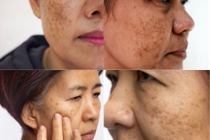 Việc hiểu đúng loại nám mình đang gặp phải là yếu tố quyết định đến hiệu quả điều trị.