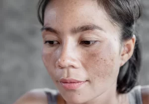 Sự thay đổi Estrogen và Progesterone – Hai hormone ảnh hưởng lớn đến quá trình sản sinh melanin.
