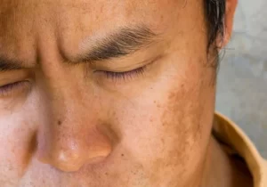 Trên thực tế tình trạng nám da ở nam giới xuất hiện ngày càng nhiều, không chỉ riêng nữ giới.