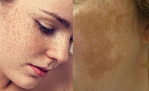 Chị em có thể phân biệt nám nội tiết và nám thông thường qua hình dạng và dấu hiệu đặc trưng.
