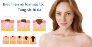 Khi cơ thể sản xuất quá nhiều hoặc quá ít melanin, da sẽ xuất hiện các vùng da không đều màu.