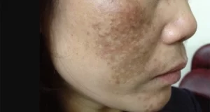 Dấu hiện rõ ràng nhất là làn da xuất hiện nhiều mảng đốm nâu hay gọi là nám, tàn nhang, đồi mồi.