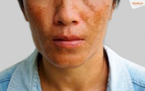 Mất cân bằng nội tiết tố kích thích melanin hoạt động mạnh, gây sạm nám rõ ở vùng gò má và trán.