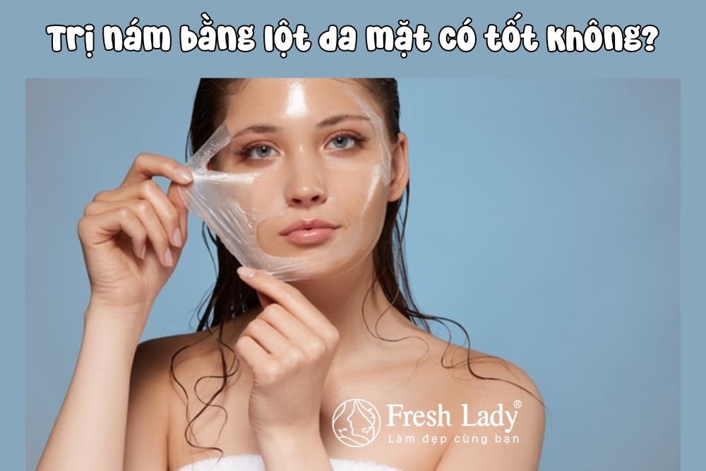 Trị nám bằng lột da mặt có tốt không? - Fresh Lady